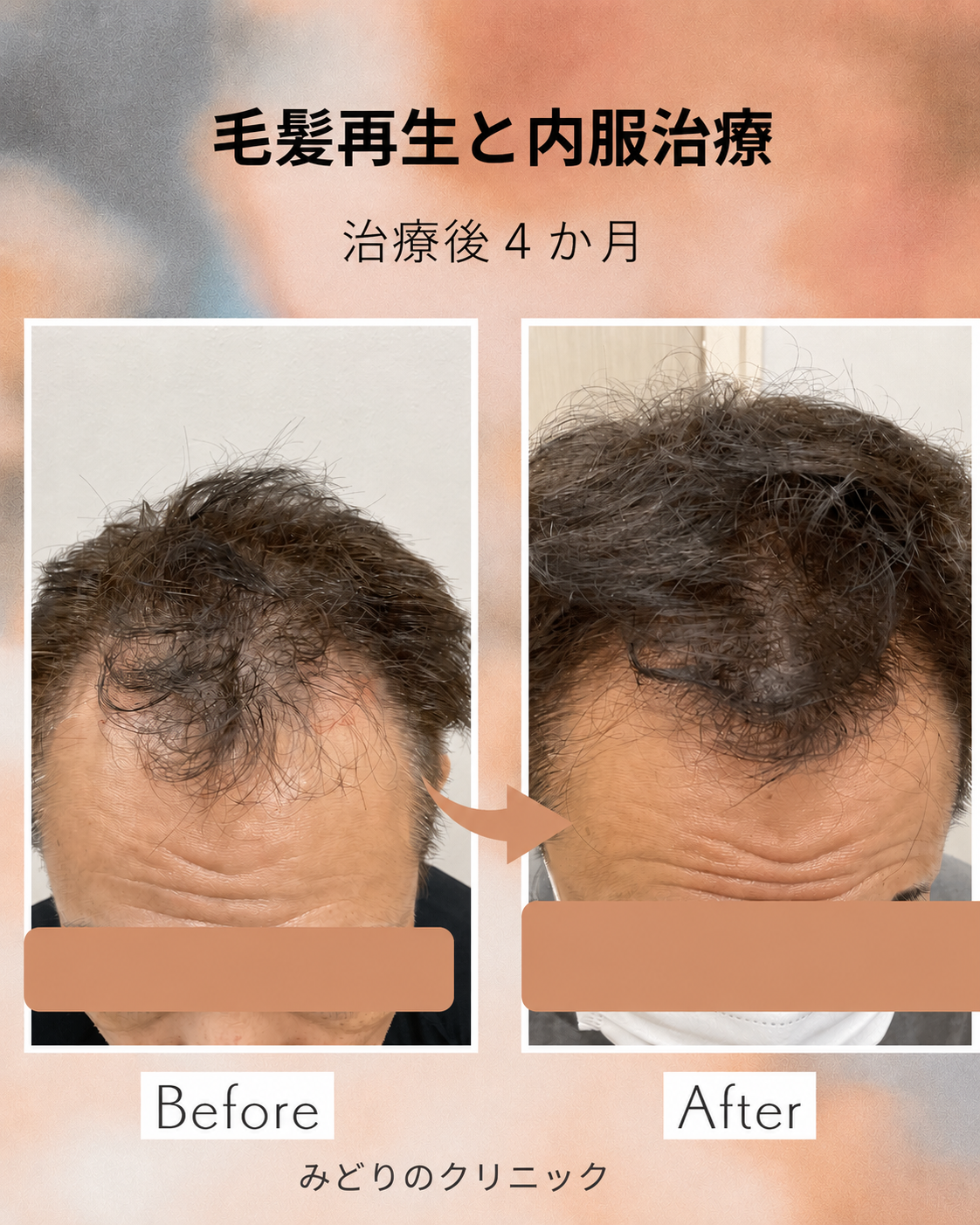 AGA治療症例写真