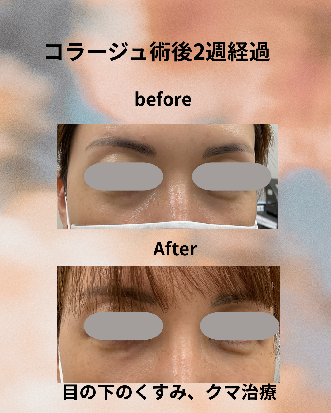 Collaju症例写真