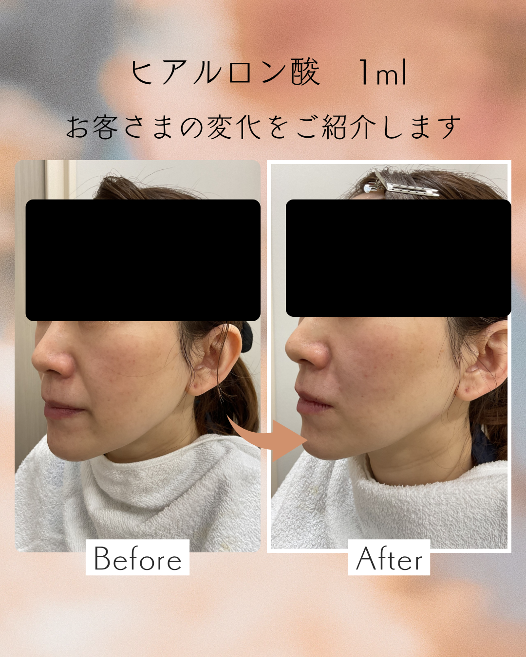 ヒアルロン酸症例写真