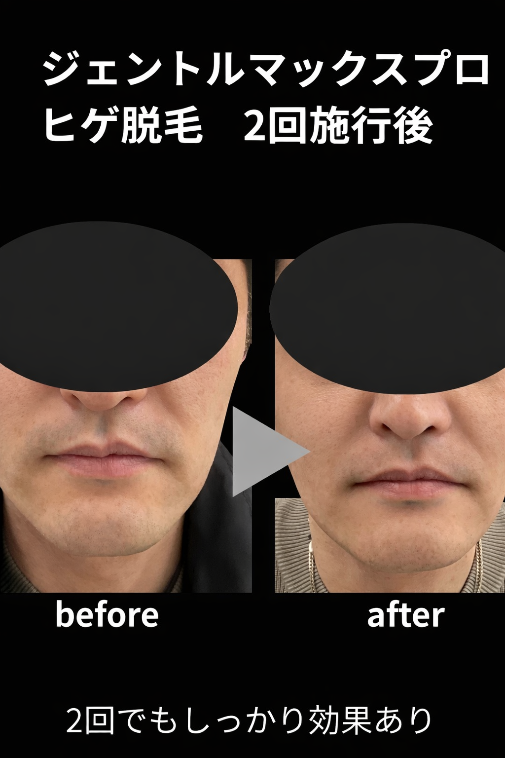髭脱毛症例写真