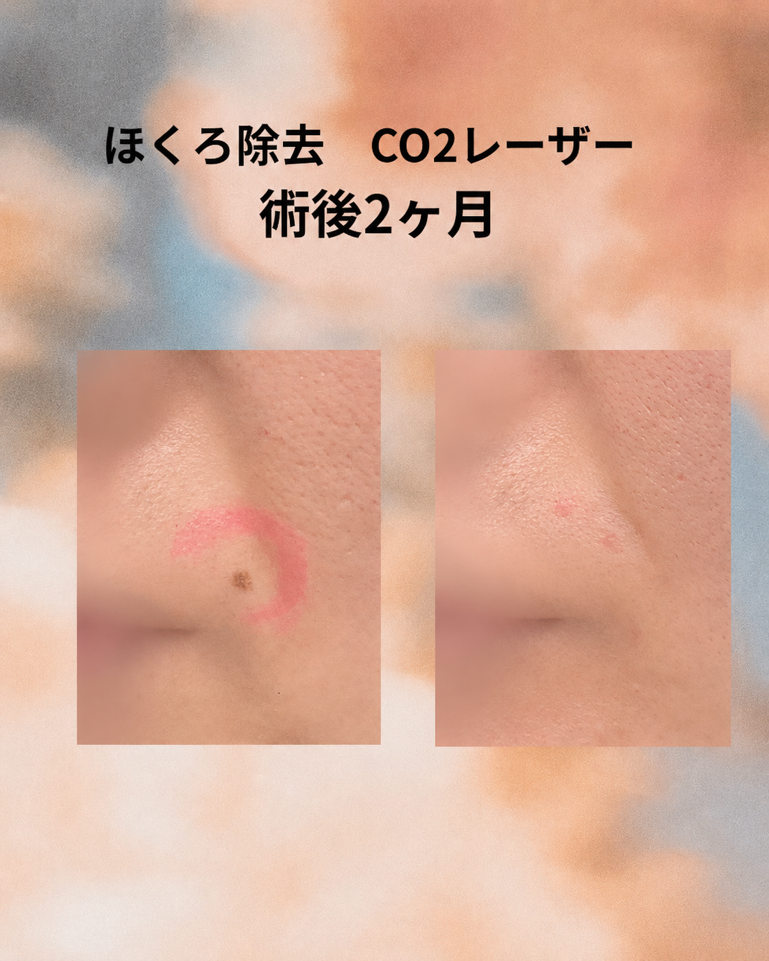 ホクロ除去症例写真