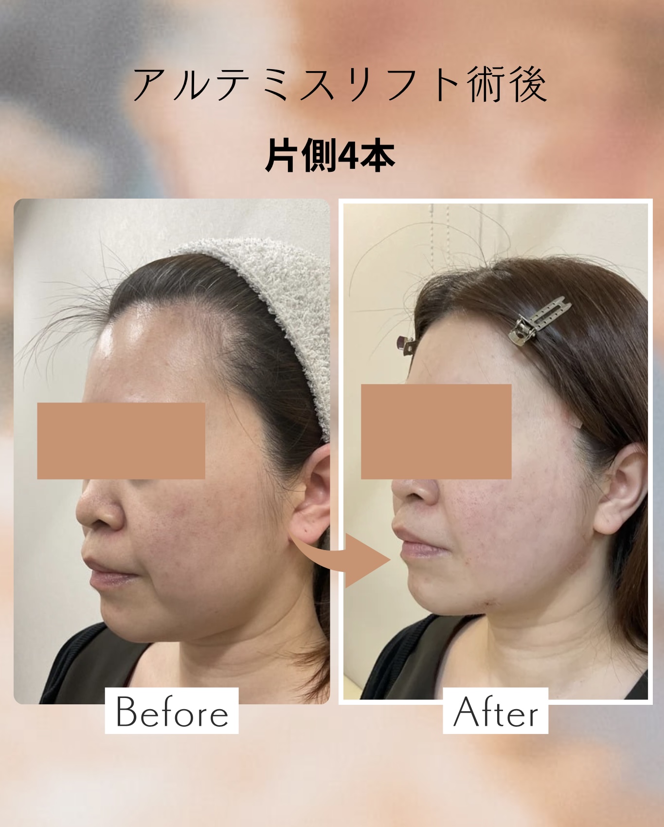 糸リフト症例写真