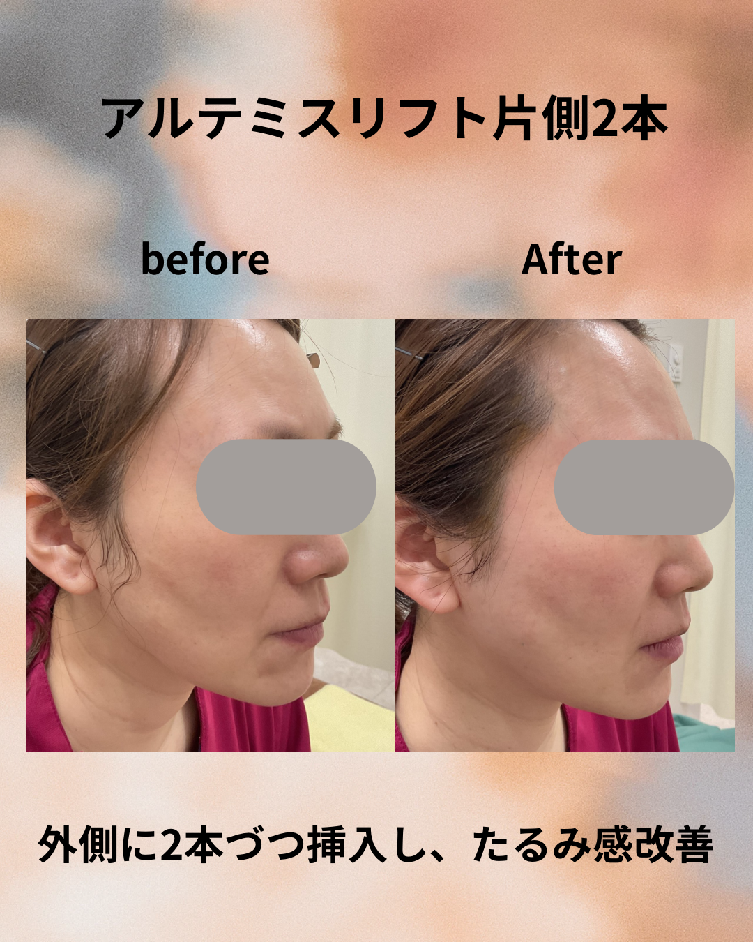 糸リフト症例写真2
