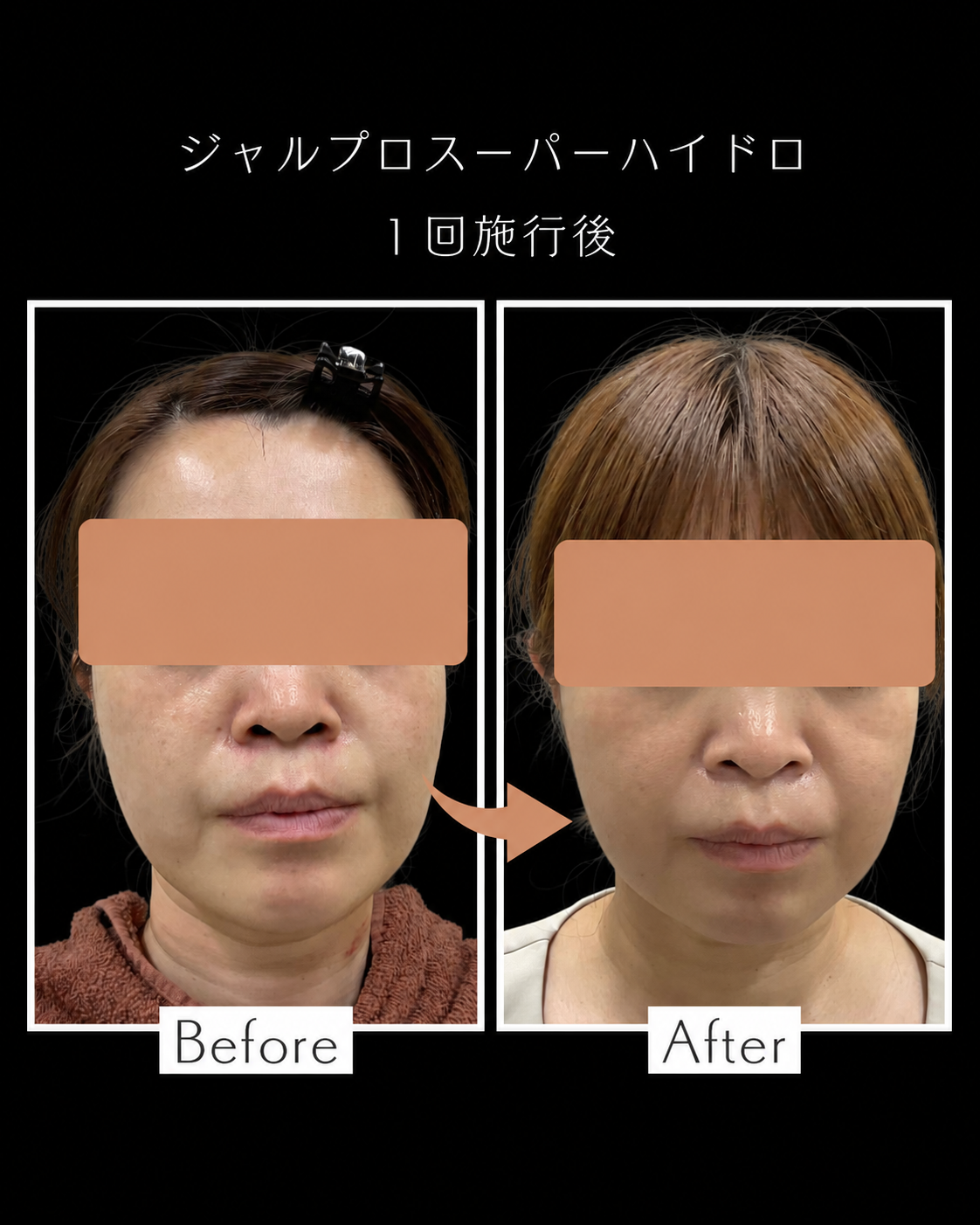 ジャルプロスーパーハイドロ症例写真