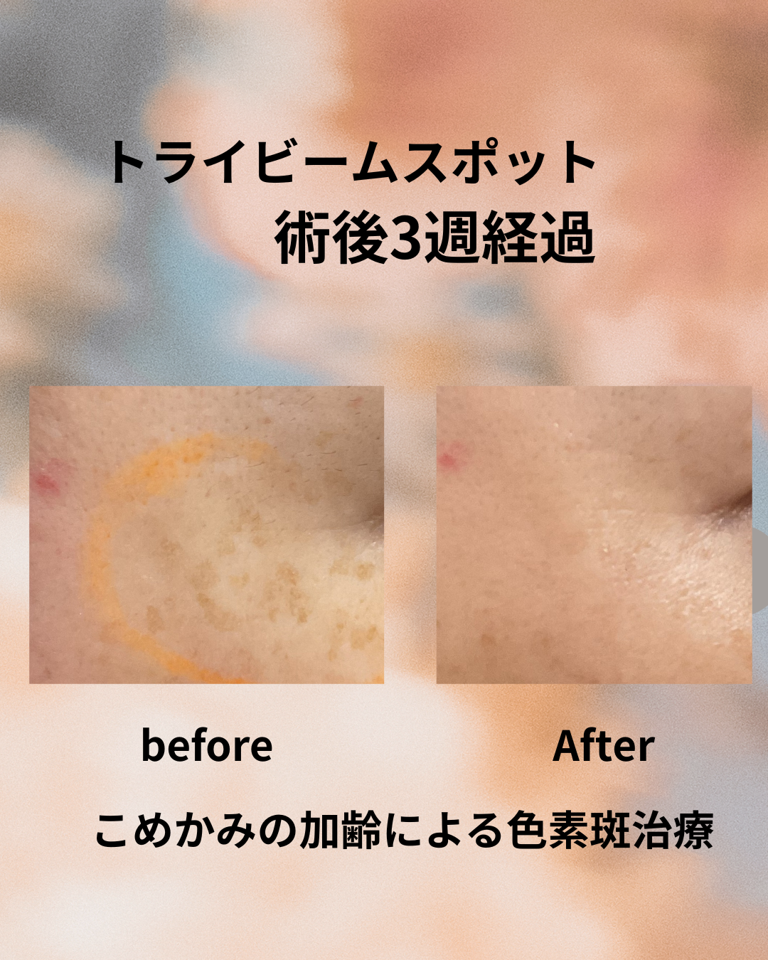 シミ取りスポット症例写真